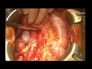 Retroperitoneal Lymph Dissection (RPLND) for Testicular Cancer