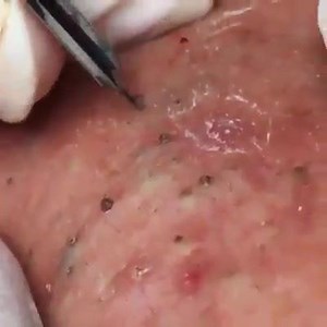 39K views · 404 reactions | Blackheads Removal | Medical Dirty | Facebook