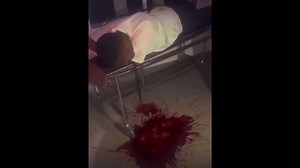 Puking blood after drink poison