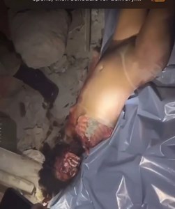 Woman Got Her Face Eaten Off By Dogs