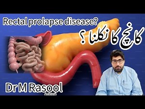 Understanding Rectal Prolapse: Causes, Symptoms, and Treatments