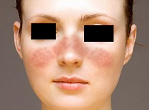 Butterfly Rash (Malar Rash) - Pictures, Treatment, Symptoms, Causes