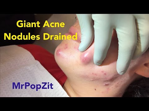 Giant Acne Drainage discussion and video dissection.
