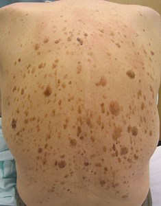 Seborrheic keratosis - Alchetron, The Free Social Encyclopedia