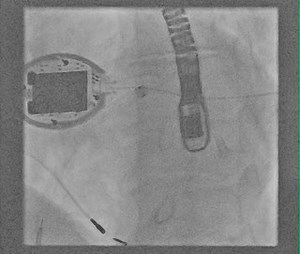 Want to learn how to transseptally deliver a leadless left ventricular endocardial pacing electrode? Watch how the atrial septum is identified before a puncture is made and crossed with a guidewire in this #JACCCEP video: http://ow.ly/d4q030gYVVU | JACC Journals