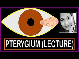 Pterygium (Lecture) - Structure, Histopathology, Excision, Prevention, Pseudopterygium, Pinguecula