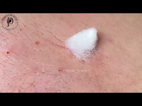 Insane Clogged Pores Removal on Cheek & Forehead — So Satisfying!