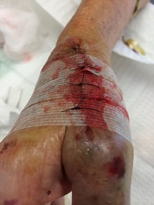 Fragile/Thin Skin Technique