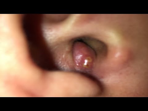 how to get rid of a boil in your ear at home fast