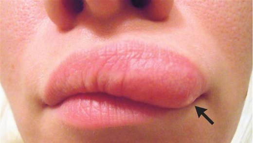 Woman discovers shifting lump on face actually a moving worm