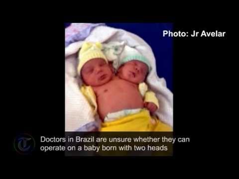 Amazing story of healthy two-headed baby born in Brazil