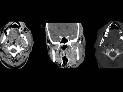 TMT: Neck Imaging by Dr Jyoti Kumar: Masticator Spaces