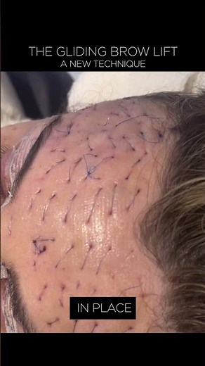 The Gliding #browlift - A New Technique | #shorts