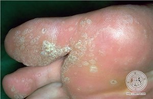 Me Estan Saliendo Muchas Verrugas En El Ano