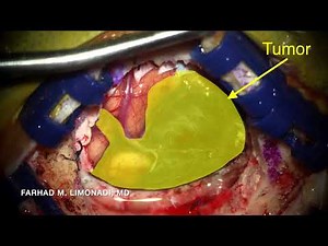 Surgical resection of two metastatic melanoma of the brain. Brain Surgery