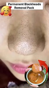 914K views · 2.9K reactions | Remove Blackheads & Whiteheads Naturally At Home . . . #blackheads #whiteheads #blackheadsremoval #whiteheadsremoval #skincare #reelsvideoシ #fbreelsfypシ゚ #reelsviralシ #fbreelsfypシ゚viralシ #reelschallenge #explorepage | Simple Home Remedies | Facebook