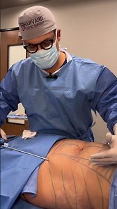 Reno/Tahoe 360 Liposuction Procedure | Dr. Erez Dayan | Avance Plastic Surgery