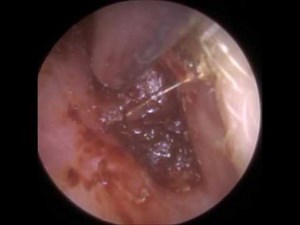 Bloody Ear Wax Removed from Painful and Narrow Ear - Mr Neel Raithatha (The Hear Clinic)