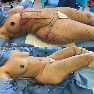 360 HD-LIPO   FAT GRAFTING TO HIPS AND BUTTOCK   INTERNAL HEATING   MINI TUMMY TUCK