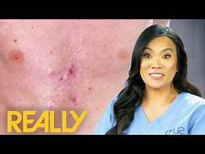 Dr Lee Pops Over 40 Pimples From Patient's Chest | Dr Pimple Popper: Pop Ups