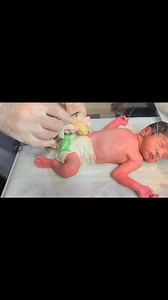 2.7K views · 89 reactions | Cute Baby NICU Checkup | Umbilical Cord Care & Cutting Procedure Explained | #BabyCare #baby #viral #nicubaby #facebookreel #foryou | Anoop Gautam | Facebook