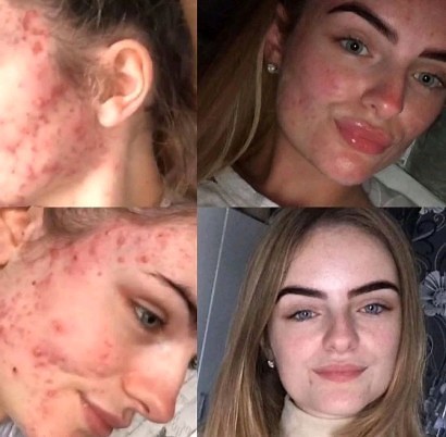 It's the best feeling giving you all these skin results, keep the amazing before & afters coming. We love what we do, thanks to you 🙏💗 #biofreshskincare #acnaut #skinresults #beforeandafter #acne #acnetreatment | Biofresh Skincare