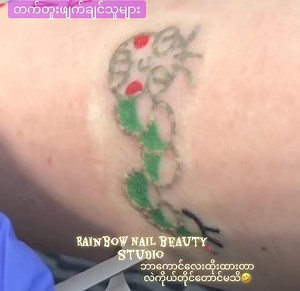 8.3K views · 38 reactions | #တက်တူးဖျက်✅ #အမာရွတ်မကျန်...