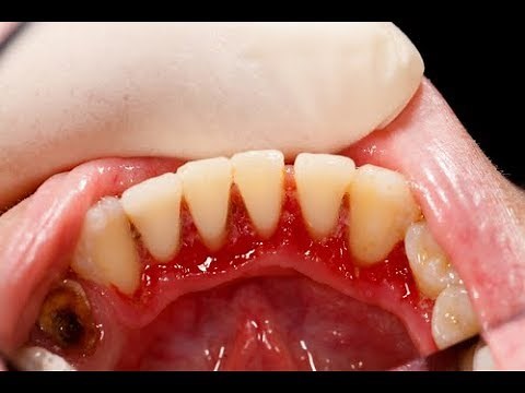 Periodontal Disease Treatment Options with Dr. Joe Nemeth & Dr. Tom McCawley