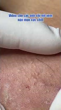 For Pimple Popping Fans: Watch This Ultimate Extraction Video!