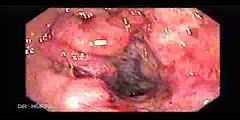 Colonoscopy of a colorectal cancer with...