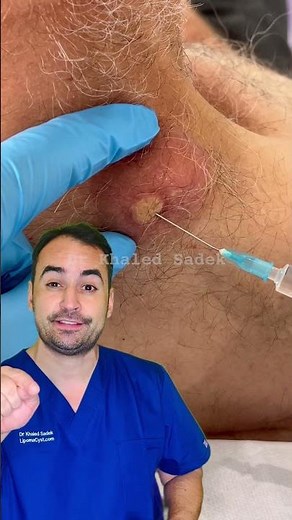 Massive neck cyst Jan 2025. Dr Khaled Sadek