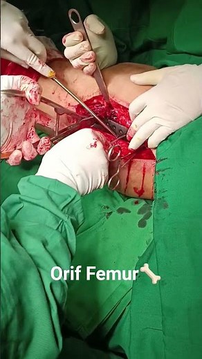 Open Reduction and Internal Fixation (ORIF) is a surgical procedure to treat a broken bone.