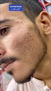 Whatsapp 0317 3555377 Wokali 24k Gold Peel Off Mask #reels | Ameenbeautytips