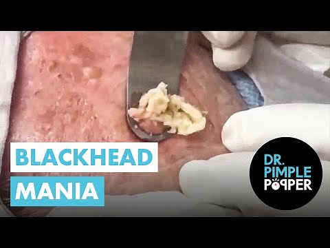 Blackhead Mania