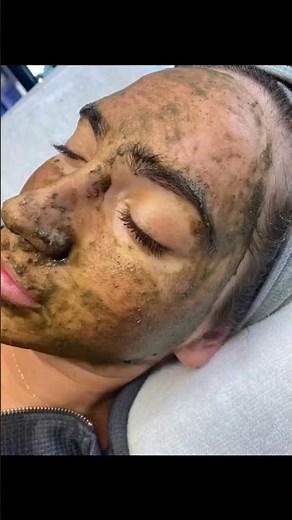 Result After One ZENA Algae Peeling Procedure