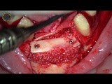Bone Augmentation in Extreme Atrophic Lower Jaw • Video • MEDtube.net