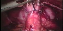 Robotic radical prostatectomy technique