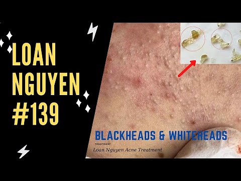 Remove many blackheads, the longest case of acne of the week (139) | Loan Nguyen