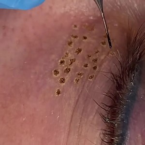 1.9K views · 7 comments | Plasma lifting the under eye! This is an extremely seamless procedure, and when shown in normal speed…you can see just how quickly this is performed! It is a quick experience for remarkable results! Tight skin, no wrinkles, and a youthful glow! Kreated by: @kellydidmybrows #kellykreation #plasmalift #plasma #fibroblast #skintightening #skintighteningtreatment #modernsalon | Kelly Kreation | Facebook