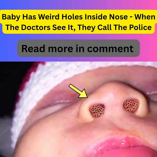 50K views · 69 reactions | Bilateral choanal atresia—where both nasal...