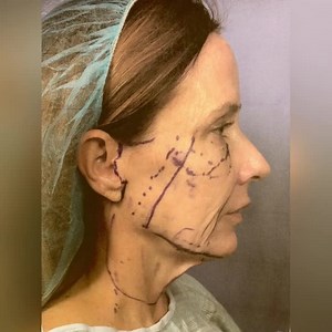 Facelift Before and After Results