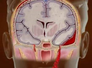 Basilar skull fracture #nervousMSHD | MedSources | Facebook
