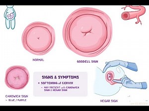 Goodell’s Sign; early sign of pregnancy, characterized by the softening of the cervix