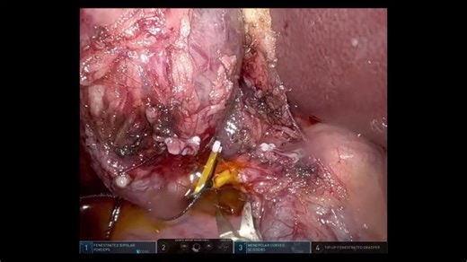 Robotic Cholecystectomy and CBD Exploration | Maitham Moslim MD DABS FACS FSSO
