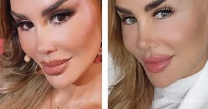 ¿Vale la pena cambiar el color de tus ojos? El peligro real detrás de la cirugía estética