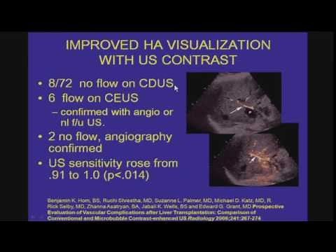 Doppler Imaging of Liver Transplants Diagnoses and Dilemmas