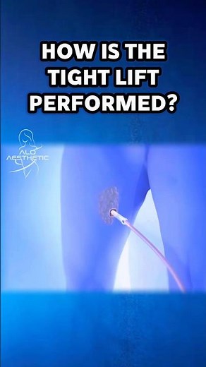 How is the thigh lift performed? Skin removal surgery at ALO Aesthetic