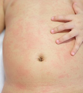 Roseola In Toddlers: Causes, Symptoms, And Care Guide