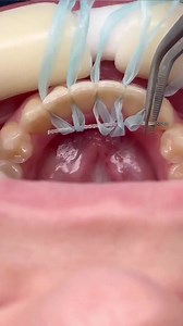 Placing a lingual retainer朗 . . By @dr.enriquecruz . . #orthodontics #ortodoncia #orthodontist #ortodoncista #bracesoff #dentistry #dental #satisfying #fyp #drenriquecruz @sonrisasorthodontics | Dentistry blog | Facebook