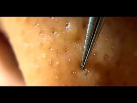 BLACKHEADS AND WHITEHEADS REMOVAL BY TWEEZERS